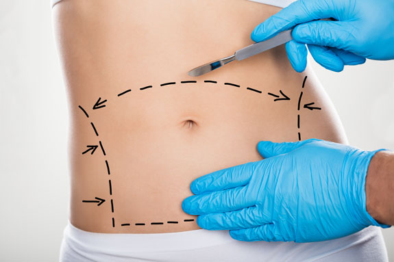 Abdominoplastik Kufstein